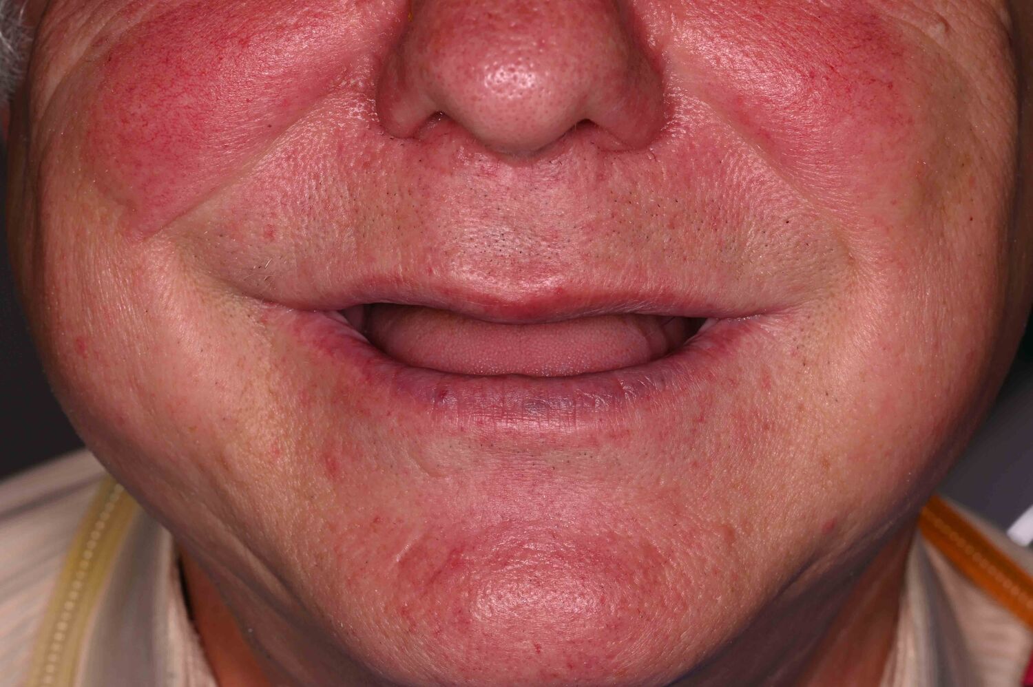 Pacient Clinica Dr. Alin Odor - Rezultat Implantologie